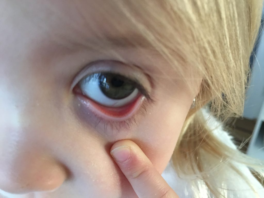 what-can-your-child-s-lower-eyelids-tell-you-about-low-iron-levels