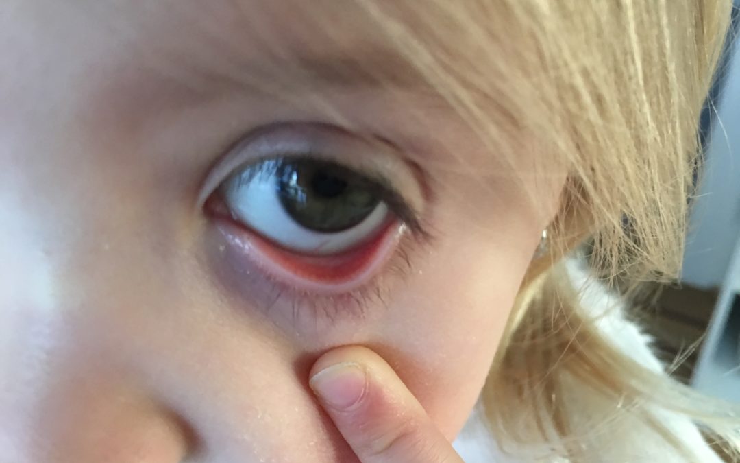 what-can-your-child-s-lower-eyelids-tell-you-about-low-iron-levels