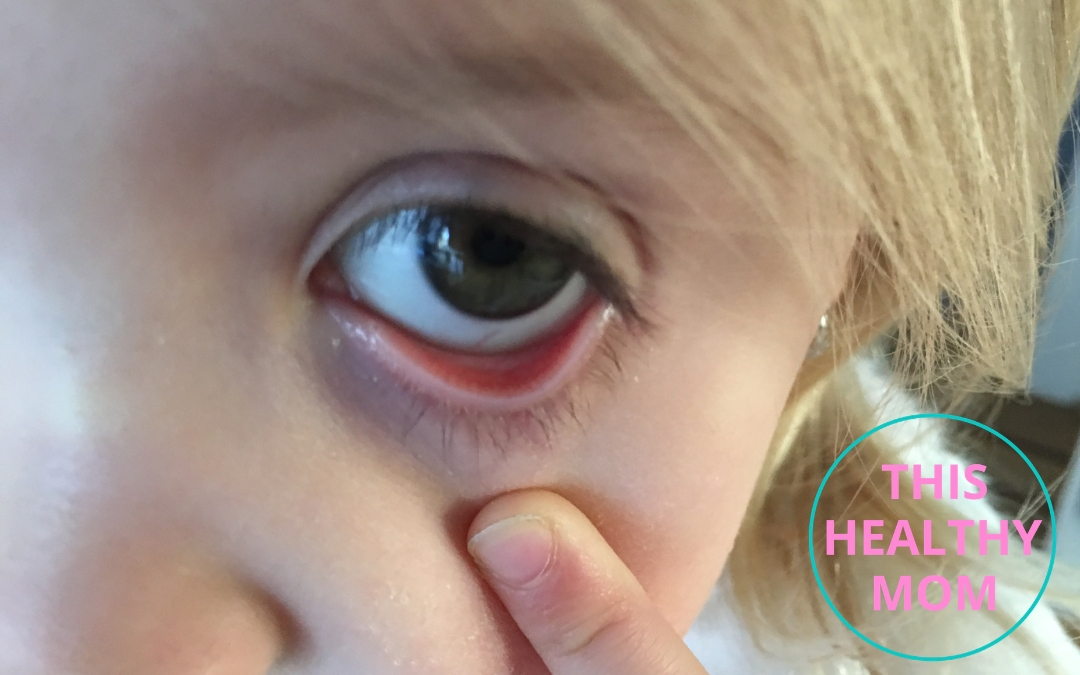What Can Your Child's Lower Eyelids Tell You About Low Iron